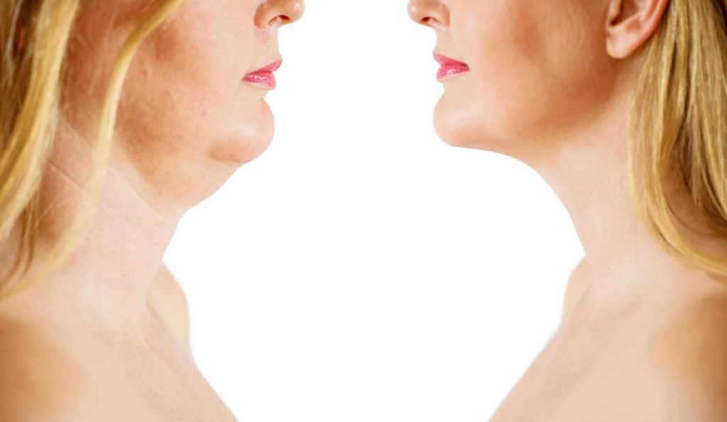 Double Chin treatment Isle of Dogs before and after results