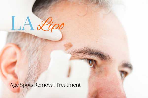What Are the Most Effective Treatments for Age Spots Isle of Dogs?
