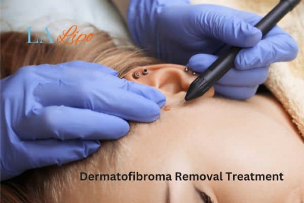 Dermatofibroma Removal Treatment Isle of Dogs