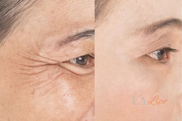 Before and after results of woman - HI-fu wrinkles reduction treatment Isle of Dogs