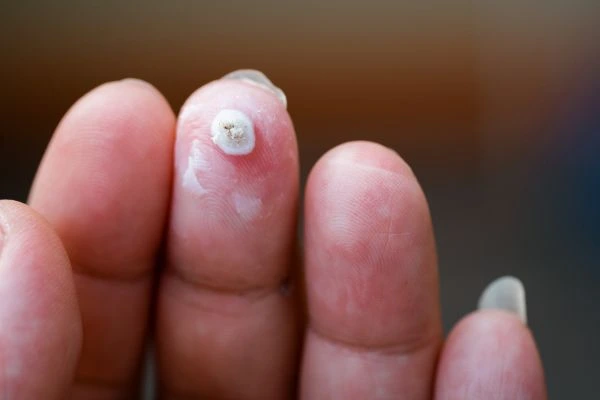 wart on person finger - cryotherapy to treat from LA LIPO Isle of Dogs