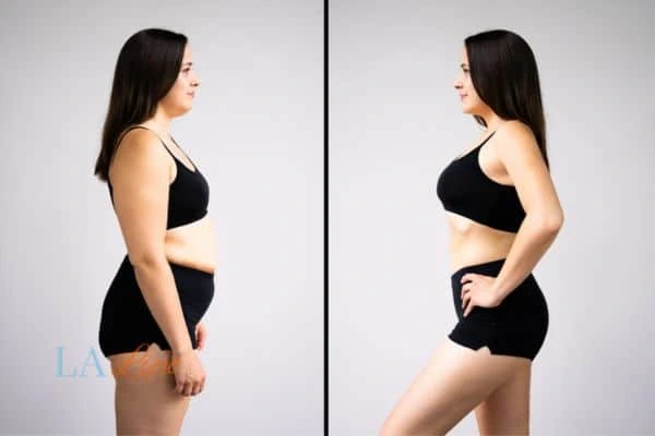 Picture of womans before and after using LA-EMS body sculpting to improve her core strength Isle of Dogs