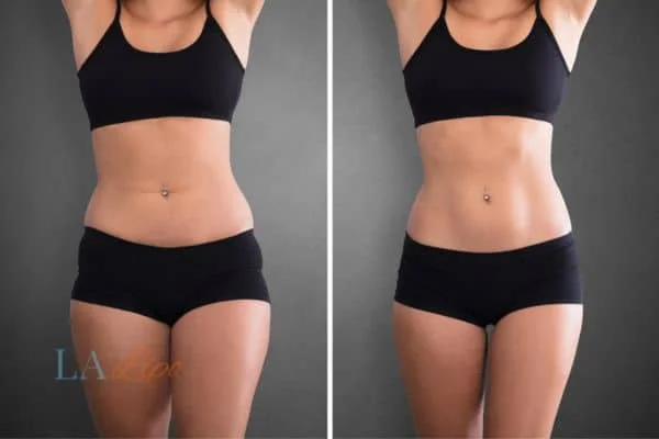 before and after results of non-surgical treatment to help a woman's body image and mental health Isle of Dogs