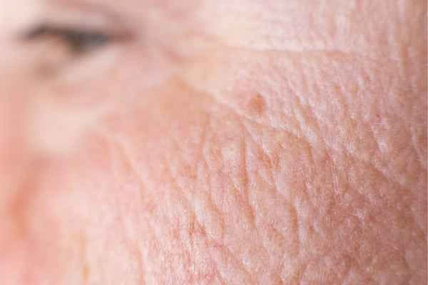 close up picture of a woman's face showing an age spot Isle of Dogs