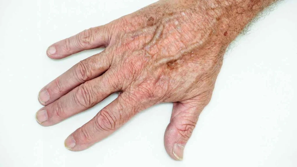Male hand showing age spot Isle of Dogs