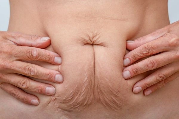 Should I Combine Diastasis Recti Treatment with Body Contouring for Better Results Isle of Dogs?