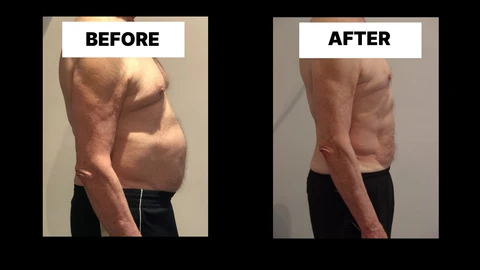 What Symptoms Can Diastasis Recti Cause in Men? Weak Core, Back Pain and Poor Posture Isle of Dogs